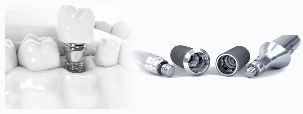 A Straumann implant supporting a crown in the arch, and the parts of the implant system